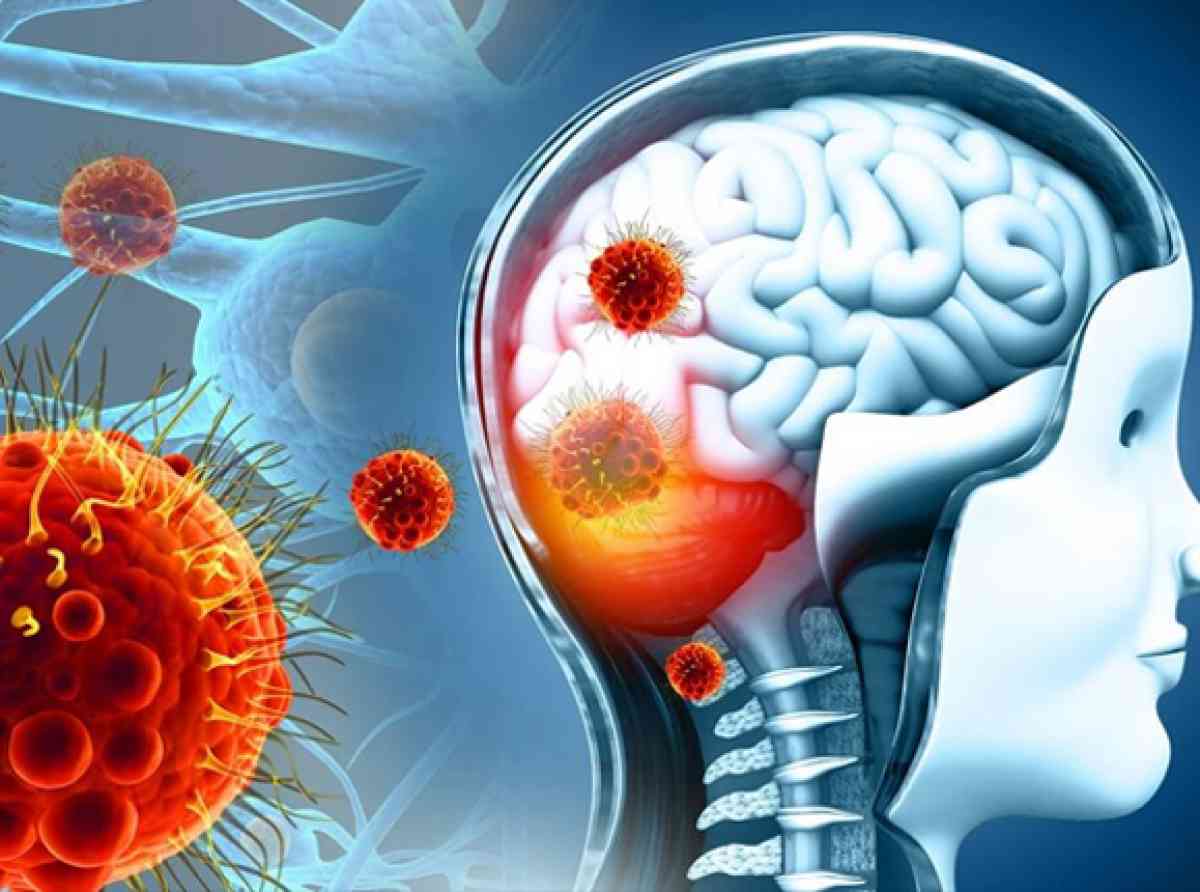 මෙනින්ජිටිස් (Enteroviral Meningitis) රෝගී තත්ත්වය පැතිරීම සහ වැළැක්වා ගැනීමට විශේෂ උපදෙස් මාලාවක්